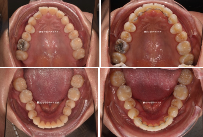 Short-Term Orthodontic Treatment Period for an Overseas Korean in Their 40s with Anterior Crossbite and Buck Teeth image 9
