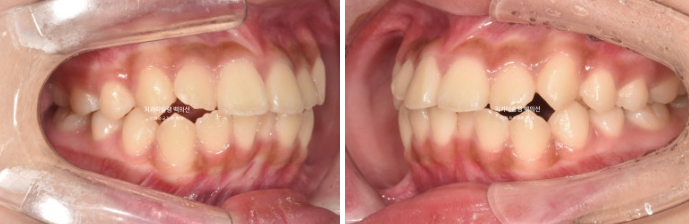 돌출입 무턱 인비절라인 발치교정 덧니 치료기간 1년 11개월 관련 이미지 3