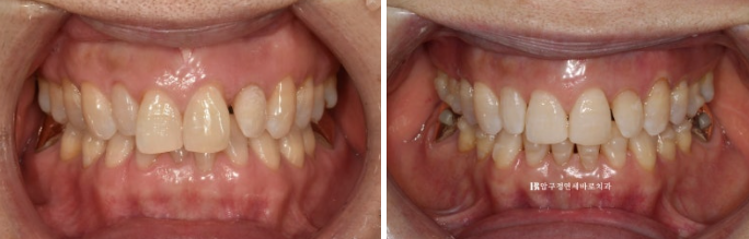 50s Invisalign Lite No-Prep Laminate Bunny Teeth image 9