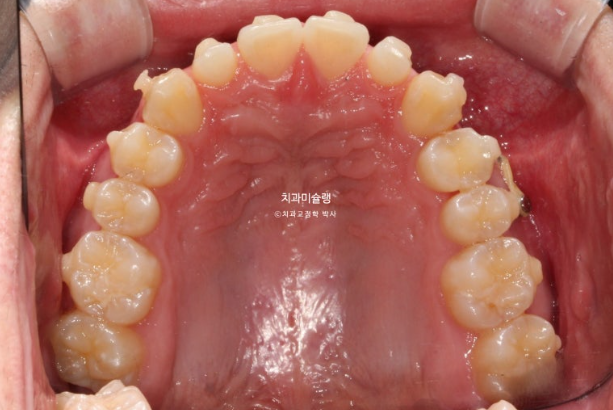 비대칭 비발치 거미스마일 잇몸미소 중심선 가위교합치료 무삭제 라미네이트 관련 이미지 16