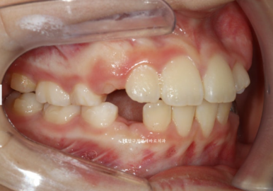 소아 투명교정 인비절라인 퍼스트 후기 기록 관련 이미지 6