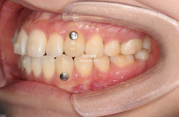 인비절라인 라이트 반대교합? 덧니 중심선 치간삭제 치료 관련 이미지 8
