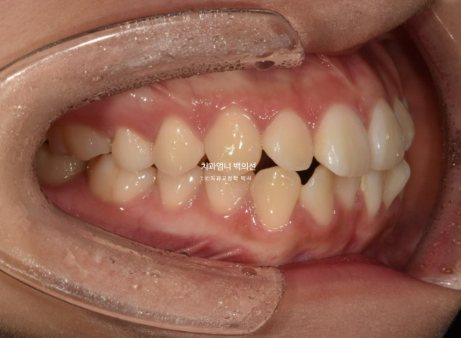 앞니 부분 교정 급속 교정 토끼이빨 MTA 미니튜브 치간삭제 치료기간 9개월 관련 이미지 3