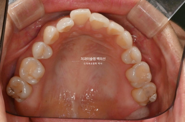 인비절라인 익스프레스 재교정 블랙트라이앵글 치간 삭제 치료기간 6개월 재제작 1회 관련 이미지 5