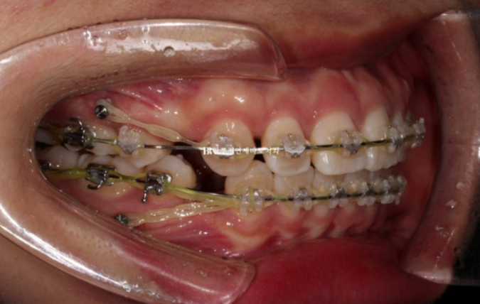 How Do the Buccal Corridors and Smile Line Change After Extraction Treatment for Protruding Teeth?|An Orthodontic Case That Also Improved Lip Incompetence image 6