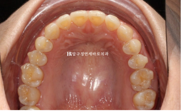 벌어진 앞니, 바로 라미네이트 하지 않은 이유｜인비절라인 후 무삭제 라미네이트 실제 사례 관련 이미지 13