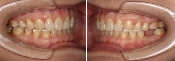 Can Gaps Between the Front Teeth Be Treated with No-Prep Veneers Alone? A Real Case Completed with Gelami After Invisalign Lite image 12