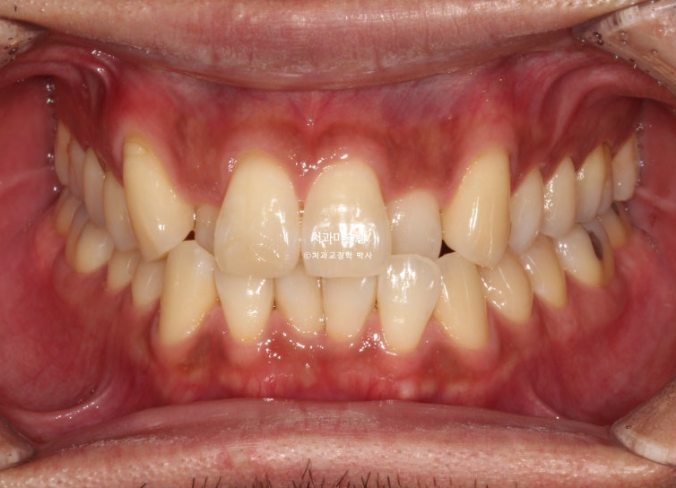 30대 MSE 악궁확장 덧니 반대교합 비발치 클리피씨 부작용 관련 이미지 1