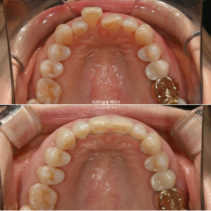 50대 치아교정 중년 발치교정 블랙트라이앵글 치료 후기 관련 이미지 19