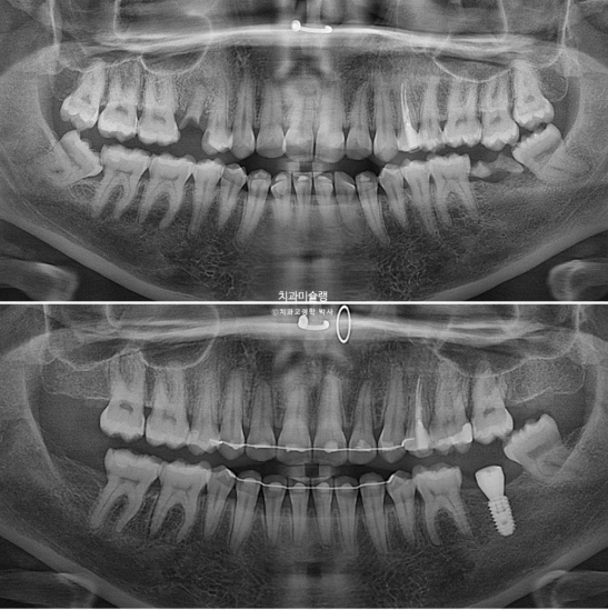 Extraction & re-orthodontics with Clippy-C, intrusion for dental implant. 관련 이미지 26
