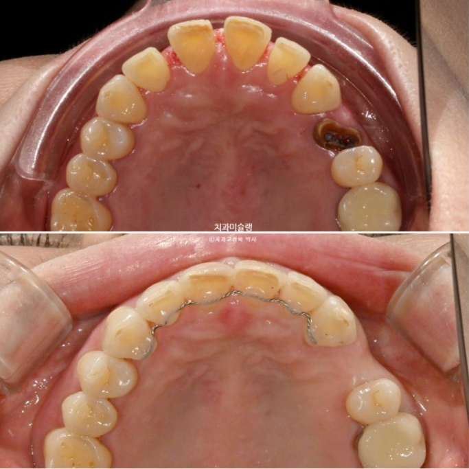 50대 치아교정 돌출 치아벌어짐 중년교정 관련 이미지 19
