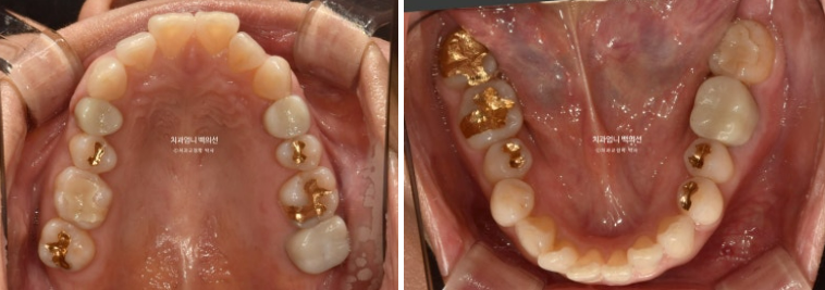 50대 치아교정 교합평면 기울어짐 토끼이 덧니 교정? 관련 이미지 4