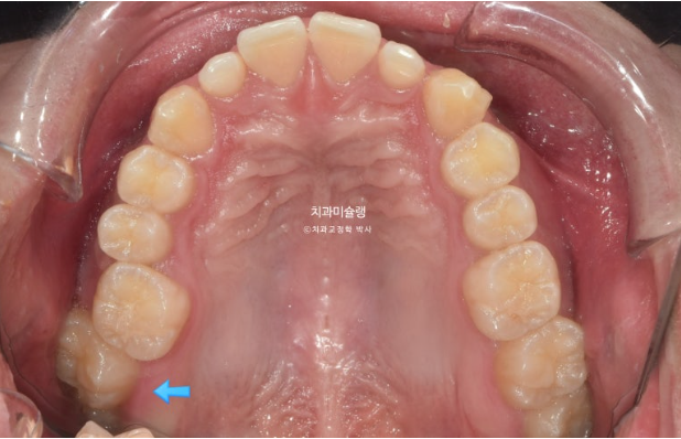 비대칭 비발치 거미스마일 잇몸미소 중심선 가위교합치료 무삭제 라미네이트 관련 이미지 5