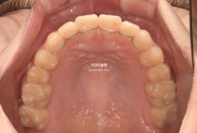 비발치 비수술 주걱턱 반대교합 재교정 치료 관련 이미지 11