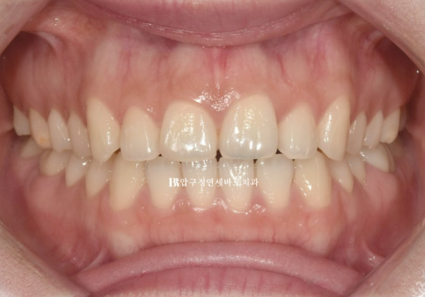 How to Create a Beautiful Smile Line? | A Real Case of Changing a Smile with No-Prep Laminates image 1