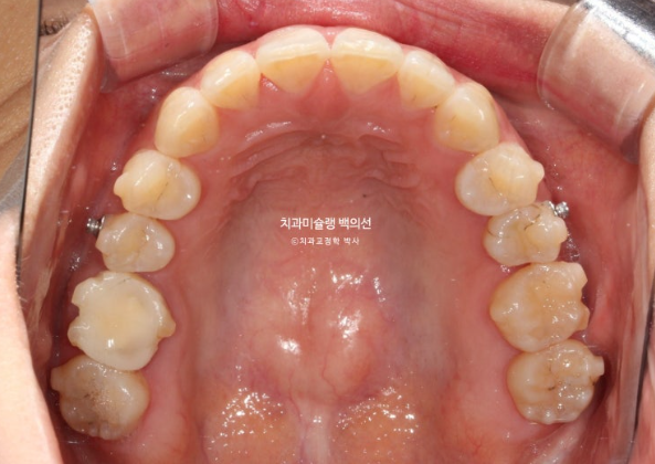 인비절라인 돌출입 발치교정 임플란트 없이 사랑니 대체 관련 이미지 15