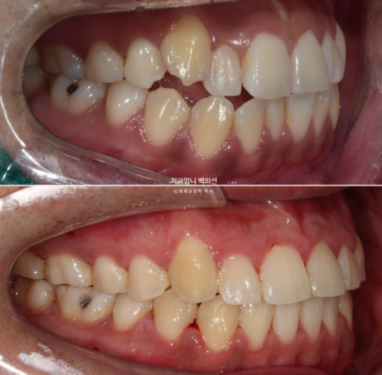 반대교합 비발치 교정 클리피씨 후기 관련 이미지 10