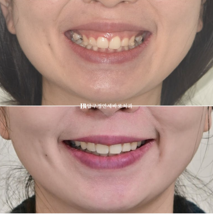 인비절라인 돌출입 발치교정 거미스마일 잇몸미소 교정 관련 이미지 13