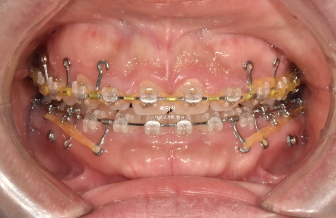 30대 치아교정 돌출입 교정 :: 잇몸미소 거미스마일 교정 입술부전증 결손치 무턱교정 관련 이미지 10