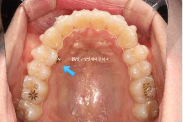 9-Month Invisalign Lite Review|Real Case Improving a Crossbite and Crooked Teeth Together image 6