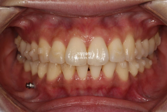 비발치 돌출입 인비절라인 교정 가위교합 중심선 맞추기 관련 이미지 8