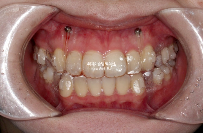 돌출입 인비절라인 발치교정 거미스마일 잇몸미소 잇몸돌출 입술부전증 무턱 재교정 관련 이미지 7