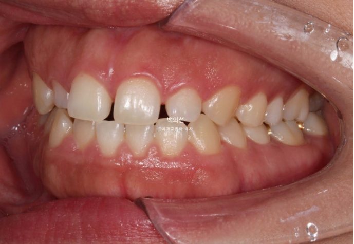 30대 치아교정 돌출입 교정 :: 잇몸미소 거미스마일 교정 입술부전증 결손치 무턱교정 관련 이미지 5
