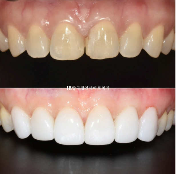 Can Gaps Between the Front Teeth Be Treated with No-Prep Veneers Alone? A Real Case Completed with Gelami After Invisalign Lite image 22