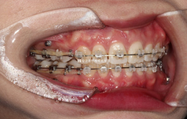 A Review of Extraction Orthodontic Treatment for Protruding Mouth | The Details of Orthodontics That Transform Buccal Corridors and Smile Lines image 7