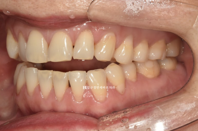 50대 인비절라인 개방교합 합입교정 미니스크류 관련 이미지 9