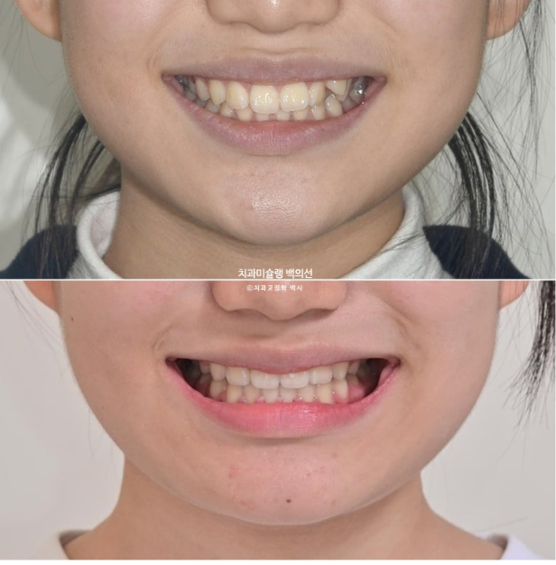 덧니 돌출입 발치교정 상악만 2개 편악 발치 클리피씨 입술부전증 치료 관련 이미지 16