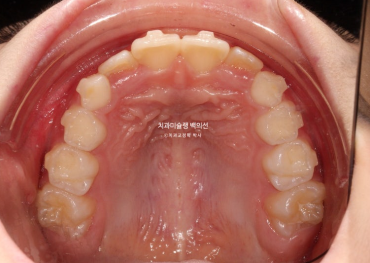 어린이 무턱 성장교정 덧니 인비절라인 퍼스트 악궁확장 치료기간 2년 관련 이미지 12
