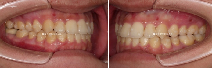 양악수술 교정 인비절라인 주걱턱 교정 치료 후기 관련 이미지 8