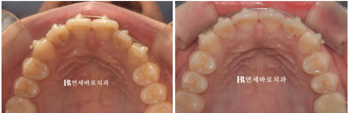 무삭제 라미네이트 아무곳에서 하지 마세요. 관련 이미지 1