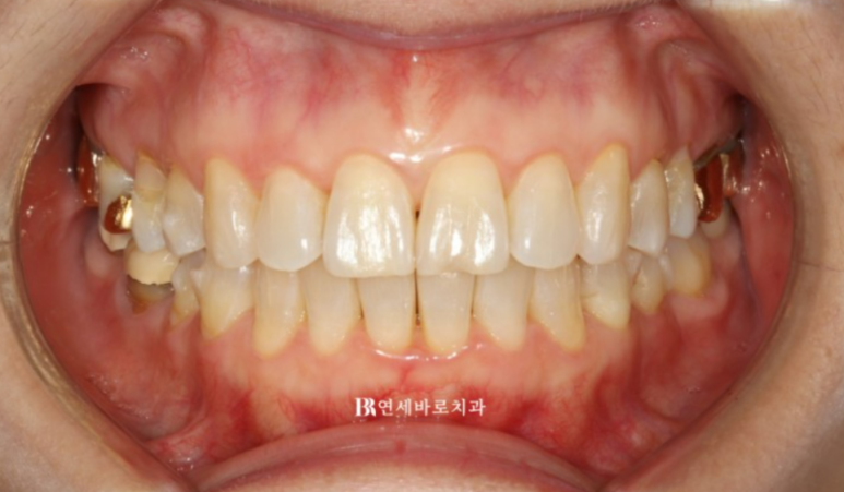 유학생 한국교정 가능할까요? 여름방학 치아교정 관련 이미지 5