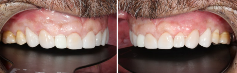 50대 중년교정 무삭제 라미네이트 중년 부분교정 후기 관련 이미지 8