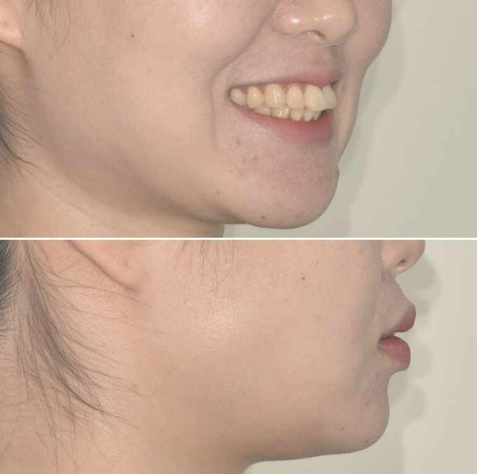 비발치 돌출입 인비절라인 교정 가위교합 중심선 맞추기 관련 이미지 7