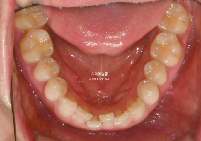 덧니 앞니 부분교정 급속교정 단기 MTA 미니튜브 기간 6개월 관련 이미지 5