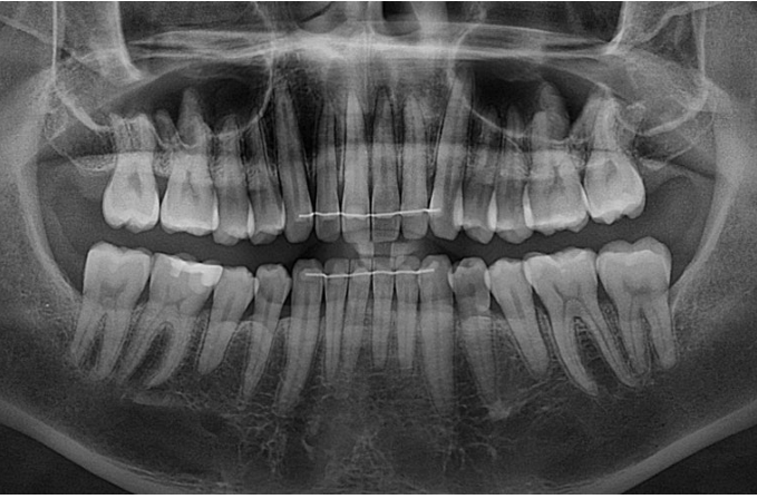 가위교합 벌어짐 중심선 과개교합 인비절라인 라이트 교정 관련 이미지 21