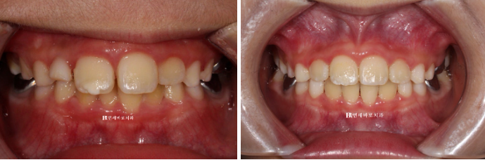 A Real Case of Preventing Crowded Teeth with Invisalign First for a Child in Gangnam image 3