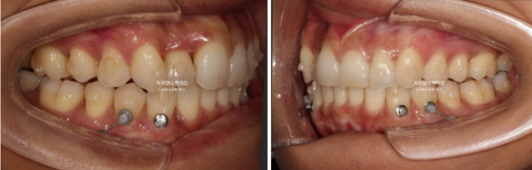 인비절라인 비발치 덧니 교정 반대교합 치료 후기 관련 이미지 9