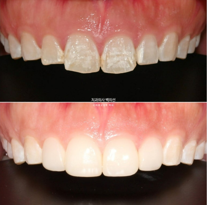 반점치 반상치 치아 하얀 얼룩 치료하기 관련 이미지 5