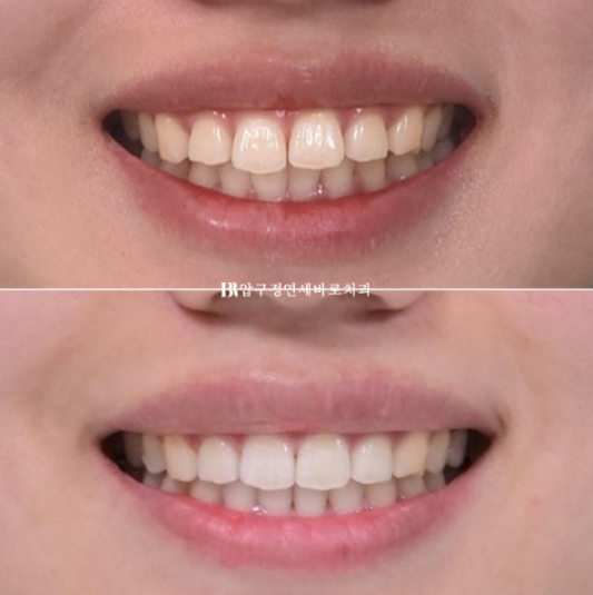 돌출입 교정 치아 벌어짐 인비절라인 투명교정 치료 관련 이미지 11