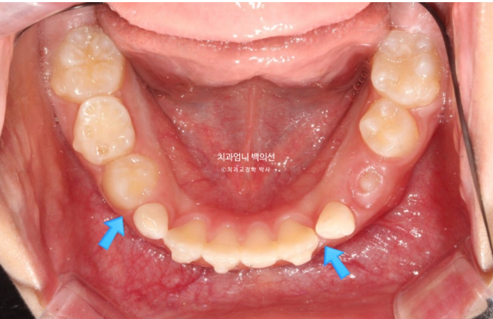 어린이 교정 인비절라인 퍼스트 비대칭 반대교합 어린이 성장 교정 관련 이미지 16