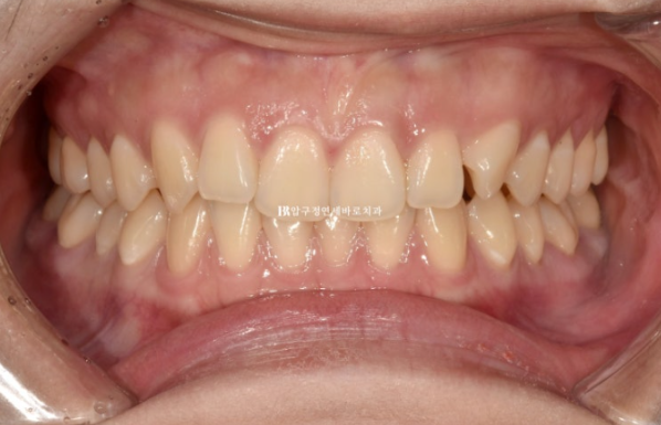 If Inward-Tilted Teeth Make Your Smile Look Constricted? Invisalign Before and After image 2
