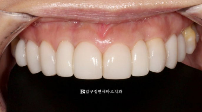 무삭제 라미네이트로 블랙트라이앵글 개선, 오래된 앞니 크라운까지 교체한 사례 관련 이미지 4