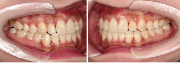 Invisalign Success Depends on Wearing Them Consistently|9-Month Real Treatment Case of Crowding & Underbite image 8