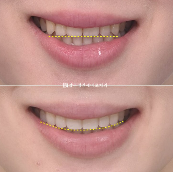 How to Create a Beautiful Smile Line? | A Real Case of Changing a Smile with No-Prep Laminates image 13