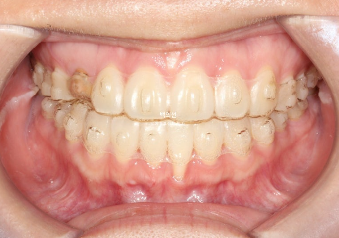 매복 결손 잔존유치 라미네이트 크라운 캔팅 인비절라인 라이트 치료 관련 이미지 9