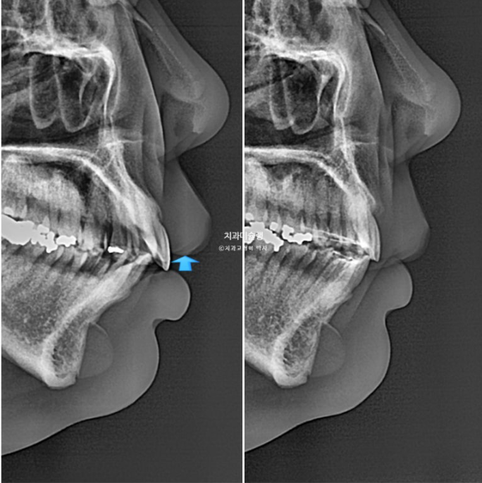 Extraction Orthodontics with Clippy-C for Protruding Mouth, Gum Smile, Gummy Smile Correction, and Treatment for a Recessed Chin image 23